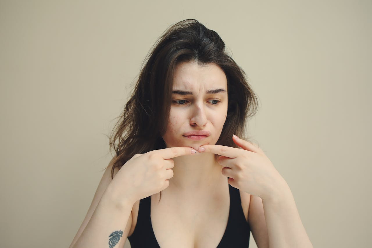 Image of a woman with oily, acne-prone skin due to blood sugar spikes