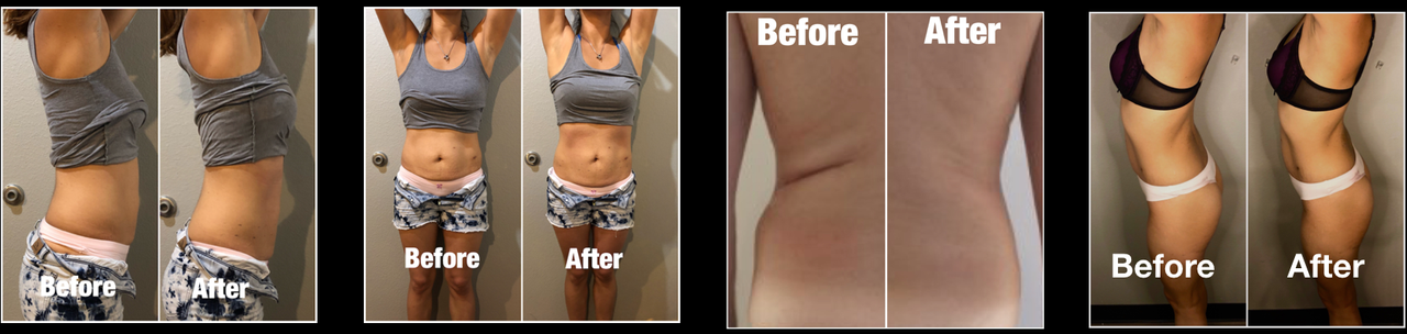 Multi cryoskin loss pic