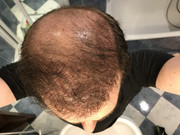 Injerto de pelo, RESULTADO INCREIBLE