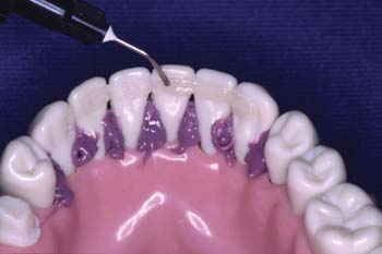Mobile Tooth Stabilization