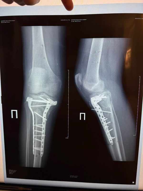 травмы Макса