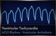 ventricular tachycardia