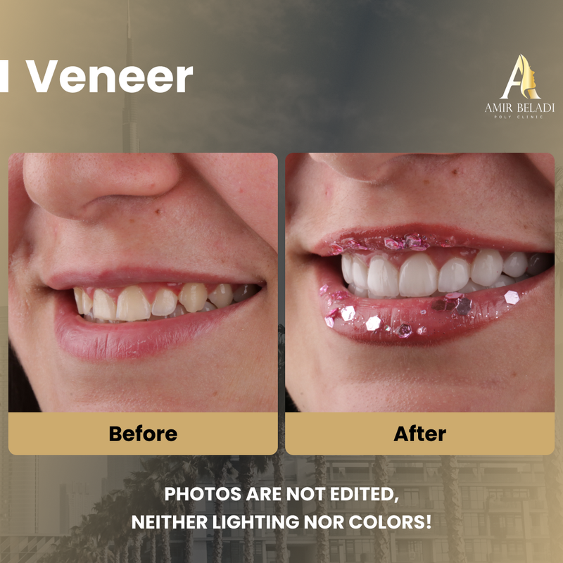 Before/After Smile 1