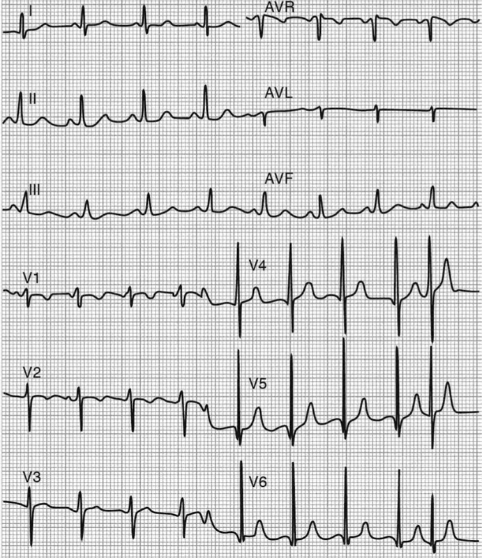 Электрокардиограмма больного с митральной недостаточностью