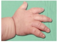 Clinical photograph showing trident hand deformity in achondroplasia