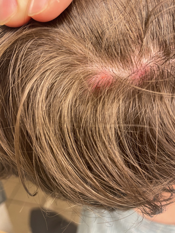 [28 M] Lymph nodes on one side of neck still painful and swollen from 2