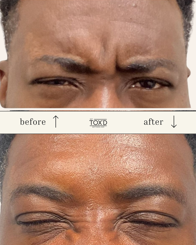 Brotox (Botox for men)