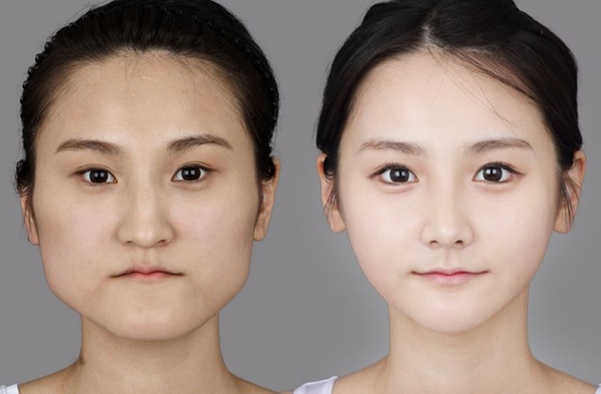 Operasi plastik viral di Korea