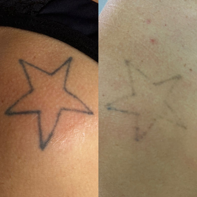 Remoção a laser de tatuagem