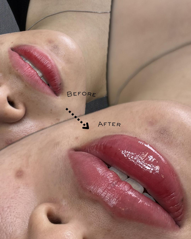 Facial contouring with Filler