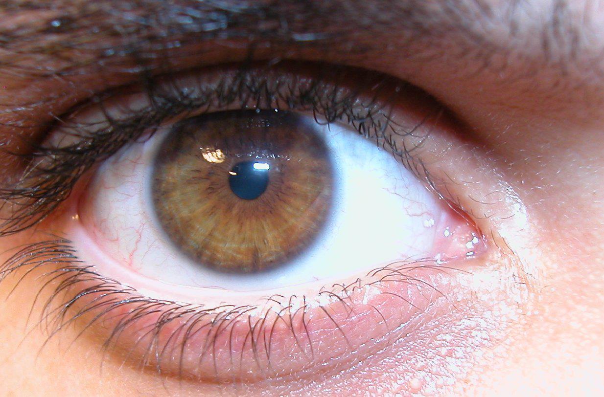 blue eyes yellow around pupil blue eyes yellow around pupil