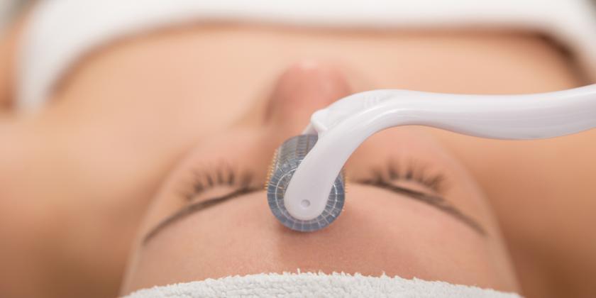 How many microneedling sessions for acne scars