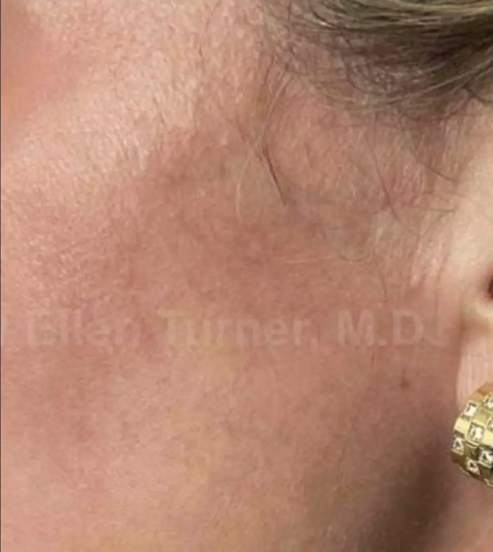 After Superficial Radiation Therapy