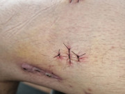 Getting surgery soon