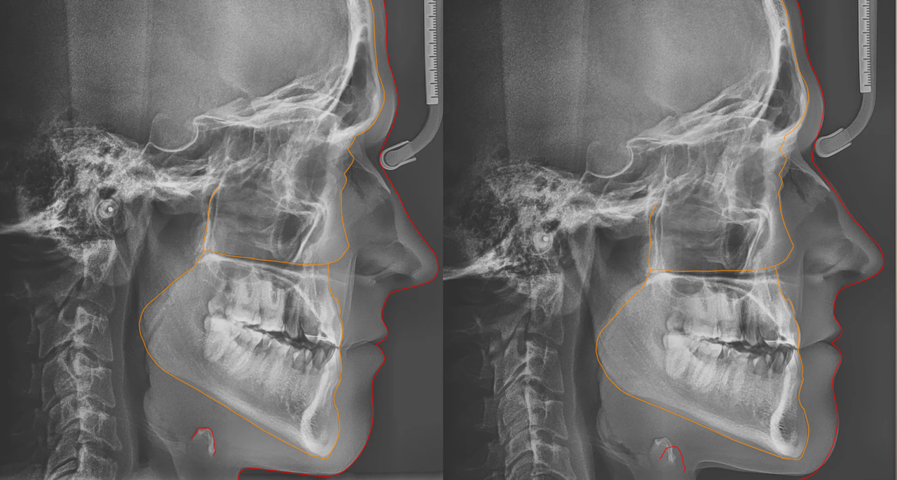 X-ray proof mewing works in adults (25+) : r/orthotropics