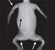 X-ray long bones showing bowed femurs, fractures, and osteopenia in osteogenesis imperfecta