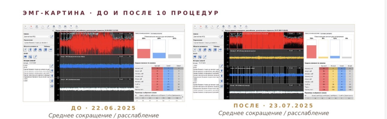 Экран БОС-терапии — ЭМГ-кривая до и после