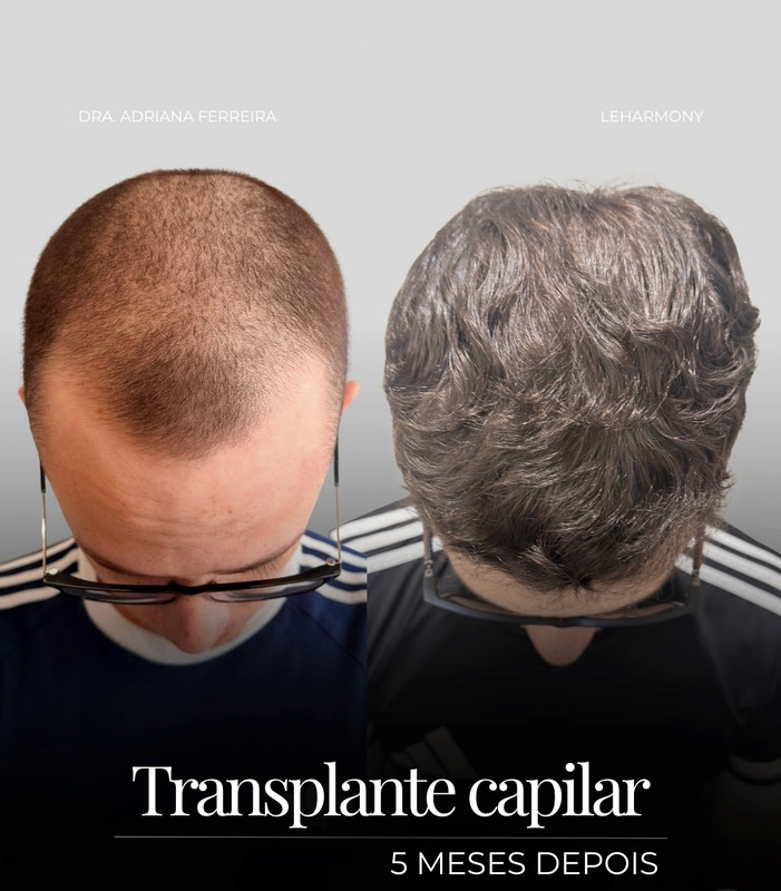 Resultado de transplante capilar 3