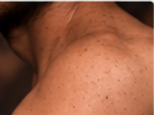 Skin Before Treatment
