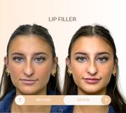 Lip filler before and after result