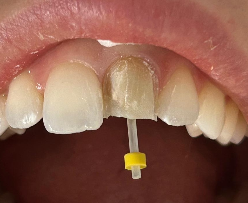 Post and Core Build-up