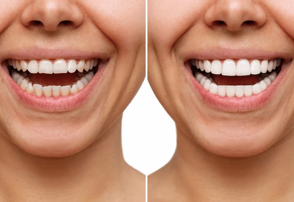 Hollywood Smile