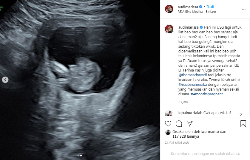 Hasil USG calon buah hati Audi Marissa dan Anthony Xie