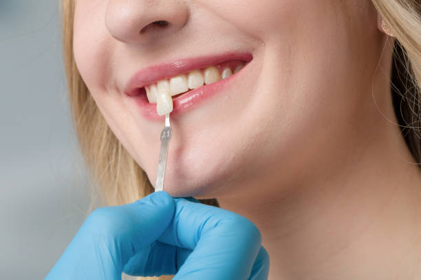 Affordable Veneers in Park Ridge IL