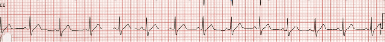 ECG
