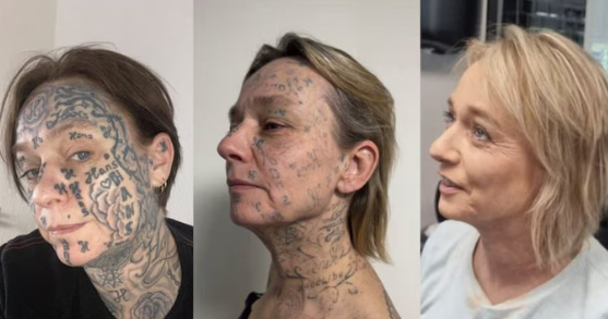 After Partner Forced 250 Tattoos Of His Name Onto Her, 52YO Woman's Tattoo Removal Transformation Stuns