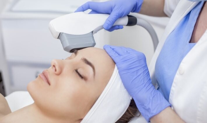 laser treatment for acne scarring