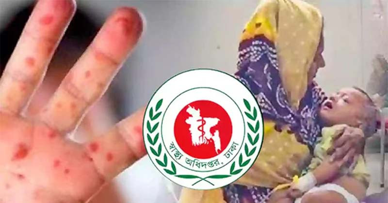হামের উপসর্গে আরও ৬ জনের মৃত্যু, নিশ্চিত শনাক্ত ৭৮