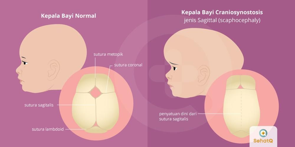 Craniosynostosis memicu menutupnya sutura di tengkorak bayi sebelum otak berkembang sempurna