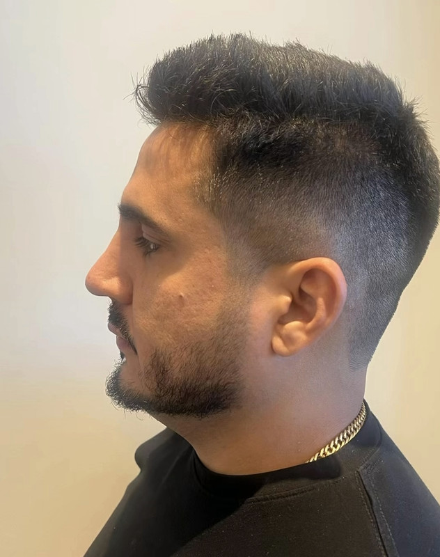 Resultado de transplante de barba 2