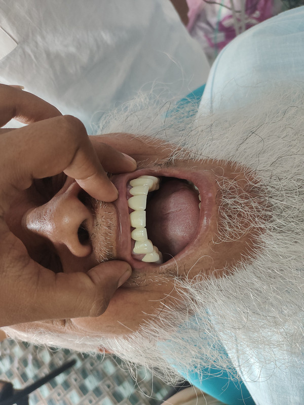 উপরের মাড়ির ১৪টি ক্রাউন লাগানোর পর