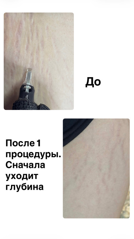 До и после процедуры 1