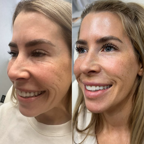 Skinvive treatment results at Let's Face It Med Spa in Denver.