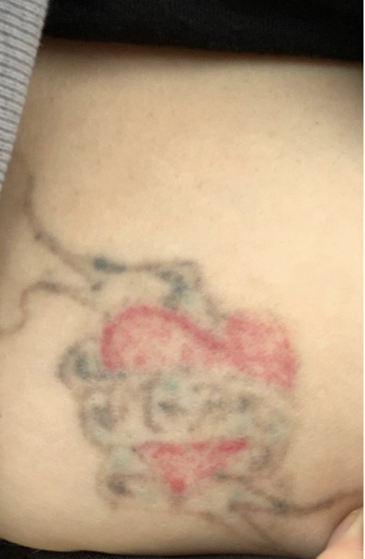 red and blue tattoo before laser removal