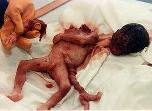 300px-Aborto4.jpg