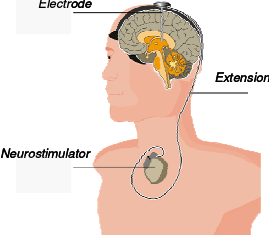 Schematic-of-Deep-Brain-Stimulation-System-While-DBS-is-not-a-cure-it-is-perhaps-the.png