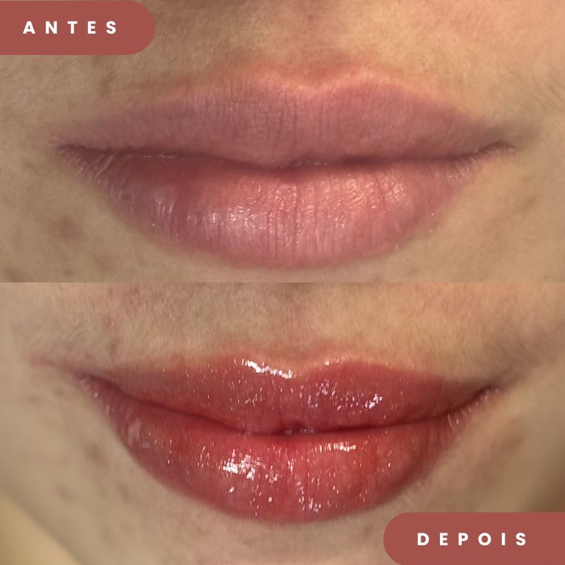 Revitalização Labial