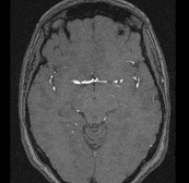 cancercerebral.gif