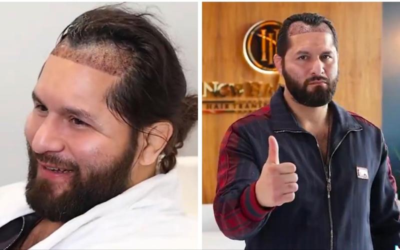 Хорхе Масвидал си присади коса в Турция