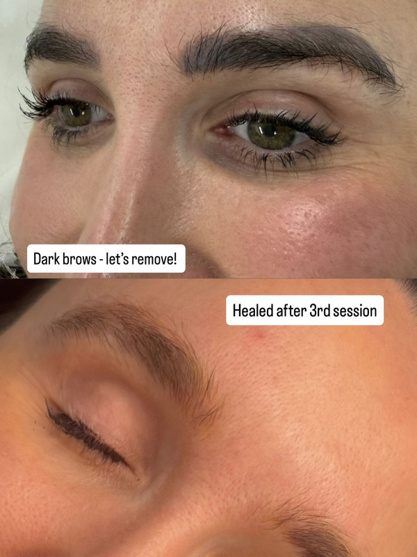 Eyebrow Tattooing & Brow Feathering in Melbourne for Natural, Fuller Brows