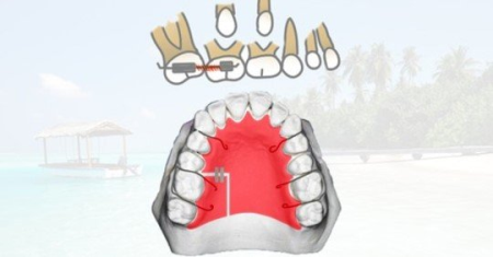 Orthodontic treatment of hypodontia and eruption problems