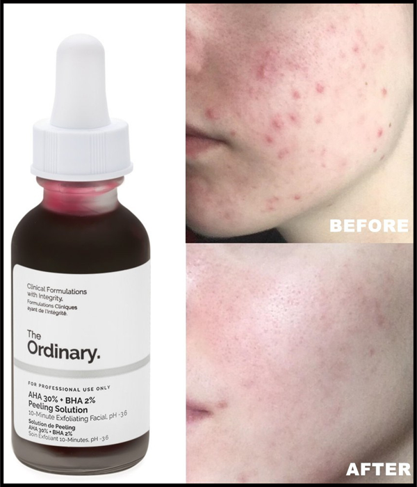 the ordinary peeling solution on acne