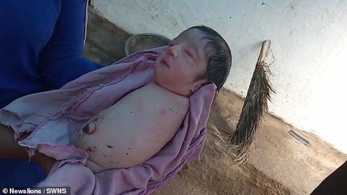 Bayi tanpa kaki dan tangan di India