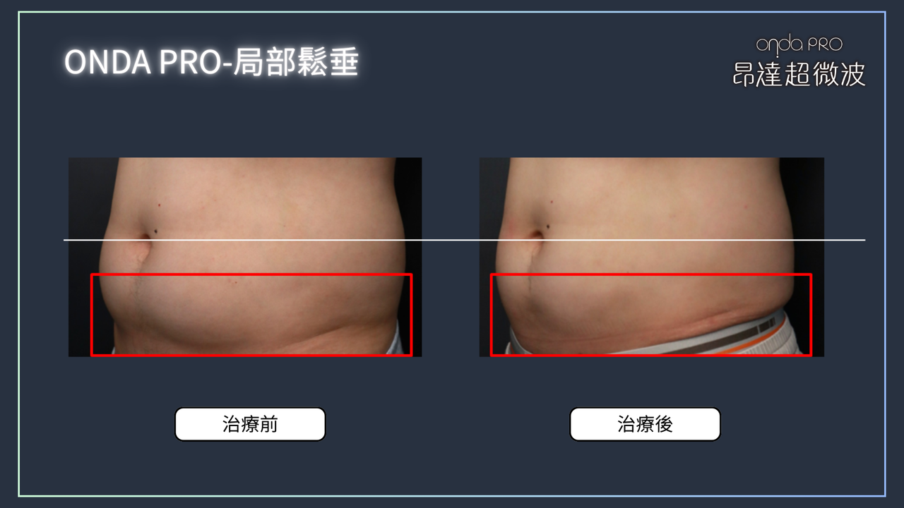 昂達超微波案例：腹部