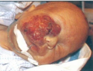 Clinical photograph showing a large facial hemangioma involving the periocular area, obstructing vision