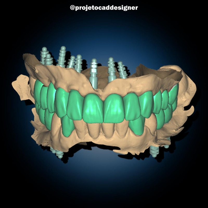 Coroas sobre Implante